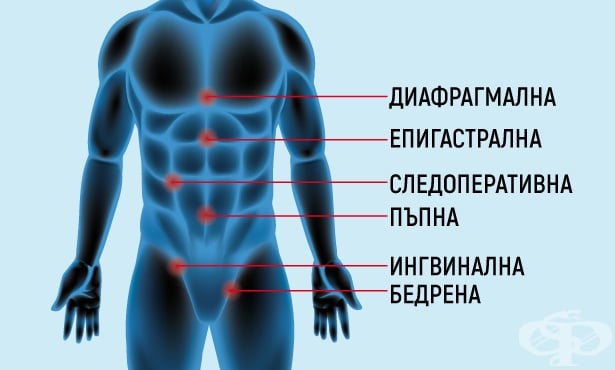 Най-чести видове херния