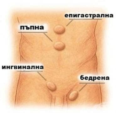 Херния