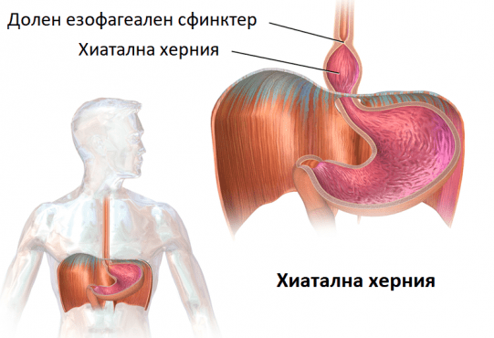Хиатална херния