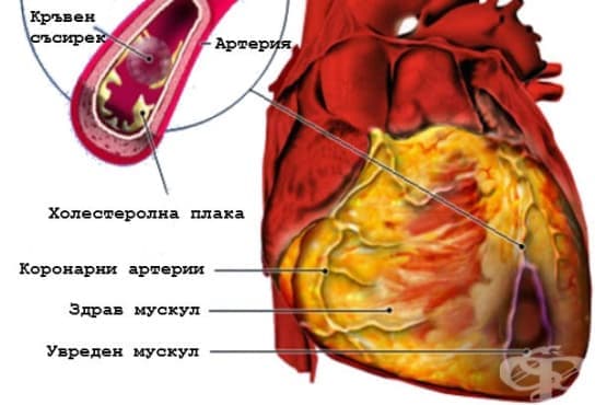 Инфаркт