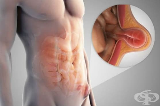 Ингвинална херния