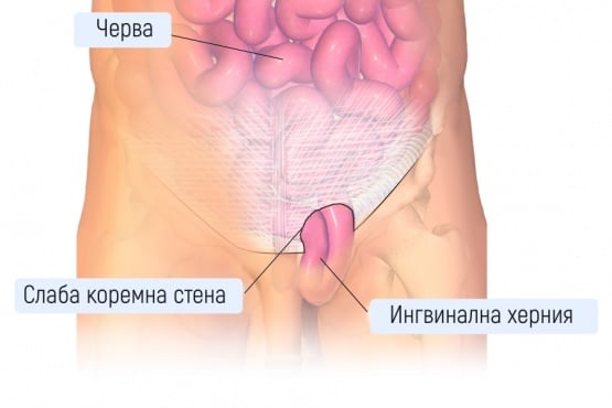 Ингвинална херния