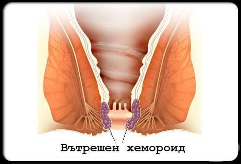 Вътрешен хемороид