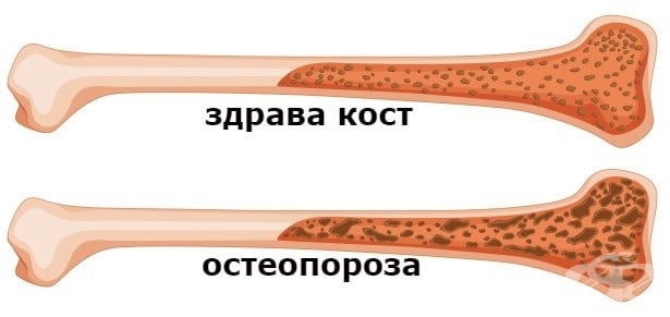 Изменения по костите при остеопороза