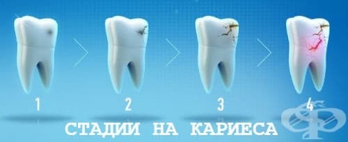 Стадии на кариеса