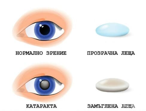 Замъгляване на лещата при катаракта