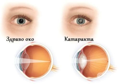 Здраво око и око с катаракта