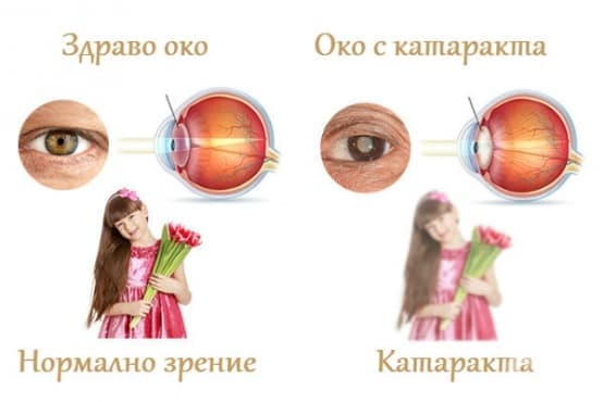Нормално зрение и катаракта