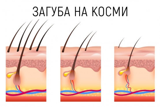 Загуба на косми
