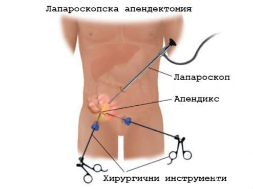 Лапароскопска апендектомия