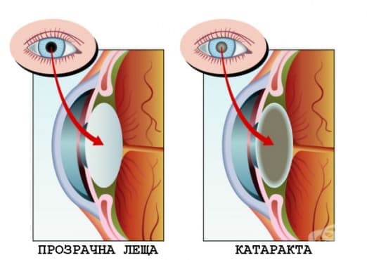 Замъгляване на лещата при катаракта