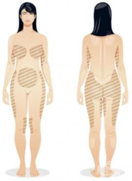 Локализация на целулита