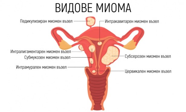 Видове миома