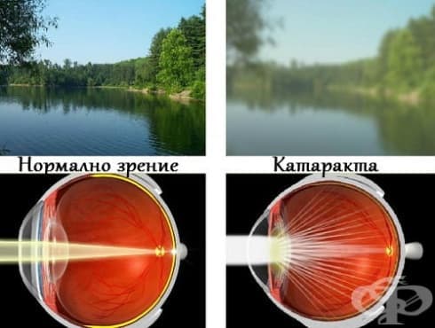 Нормално зрение и катаракта