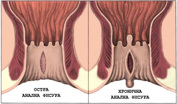Анална фисура