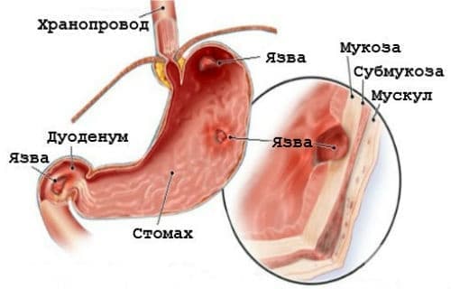 Язви на стомаха и дуоденума