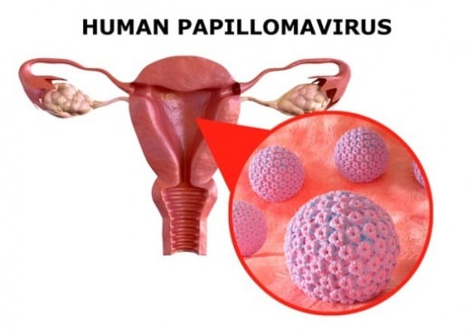 Пренеопластични лезии (преканцерози), причинени от HPV