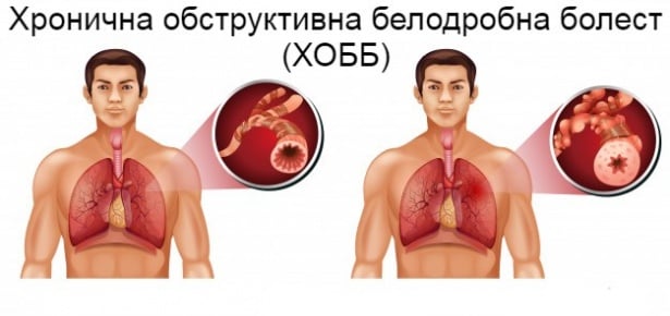 Промени в белия дроб при ХОББ