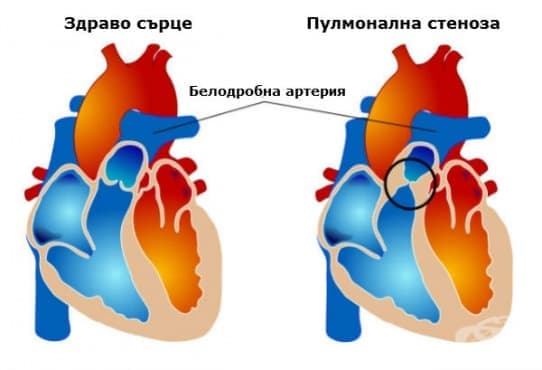 Пулмонална стеноза
