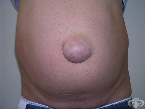 Пъпна хения при възрастен