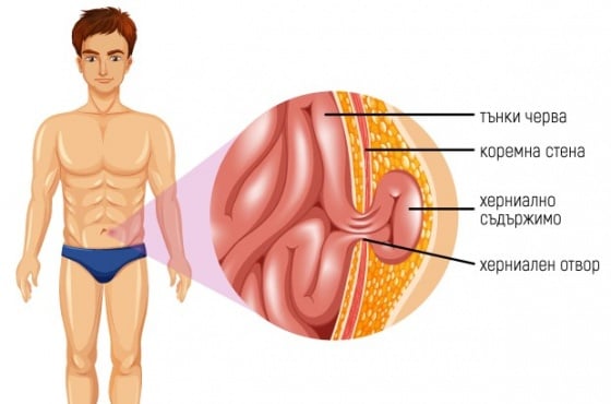 Пъпна херния при възрастни