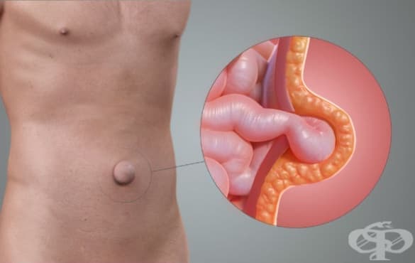 Пъпна херния