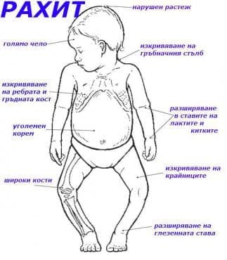 Рахит