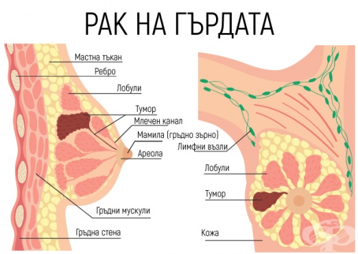 Рак гърдата