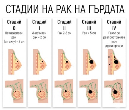 Стадии на рак на гърдата