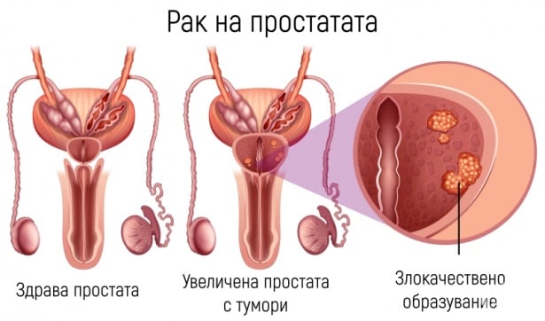 Рак на простатата