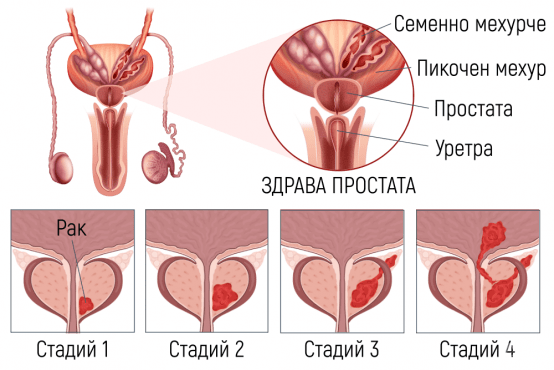 Стадии при рака на простатата