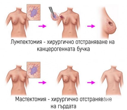 Хирургично лечение