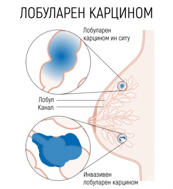 Лобуларен карцином