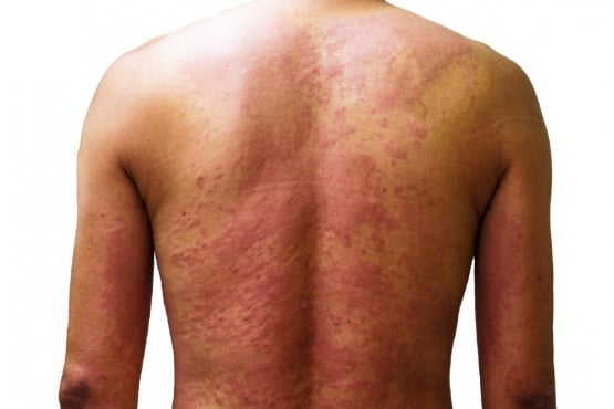 Алергичен обрив от лекарства