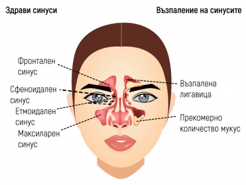 Синузит