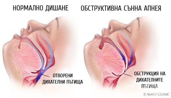 Обструктивна сънна апнея