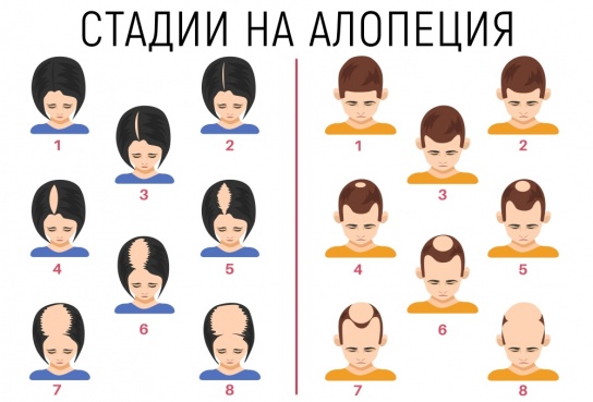 Стадии на алопеция