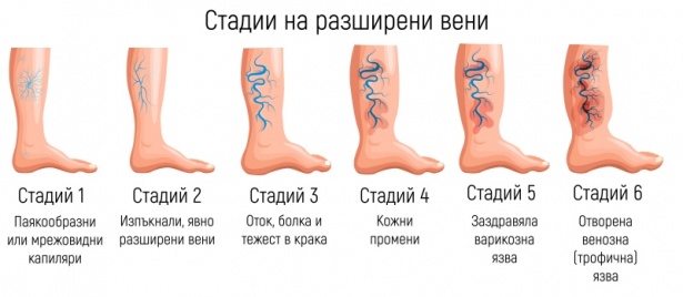 Стадии на разширени вени