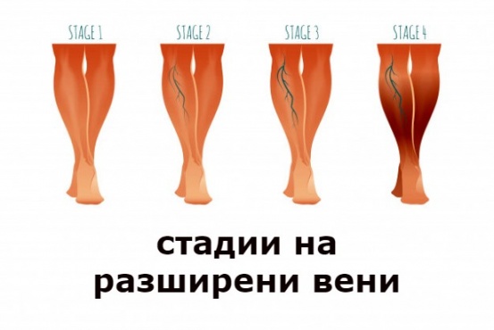 Стадии на разширени вени