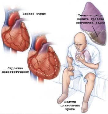 Симптоми при сърдечна недостатъчност