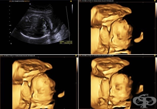 Изследване с ултразвук - 3D и 4D