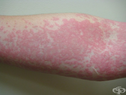 Снимка на уртикария