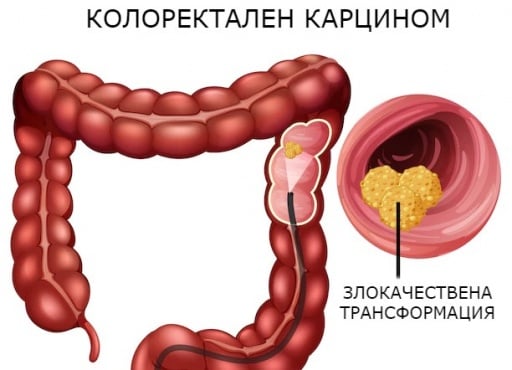 Полипи на дебелото черво: какви са леченията при полипи на дебелото черво