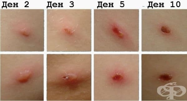 Варицела