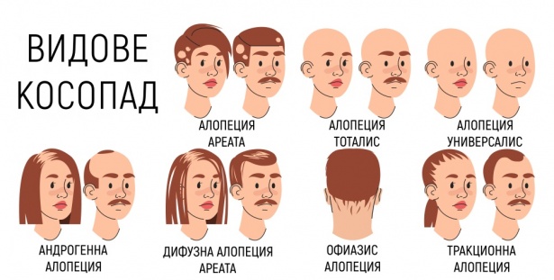 Видове алопеция