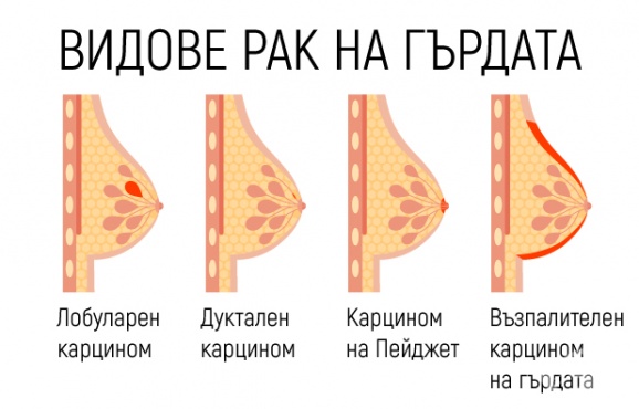 Видове рак на гърдата