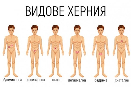 Видове херния