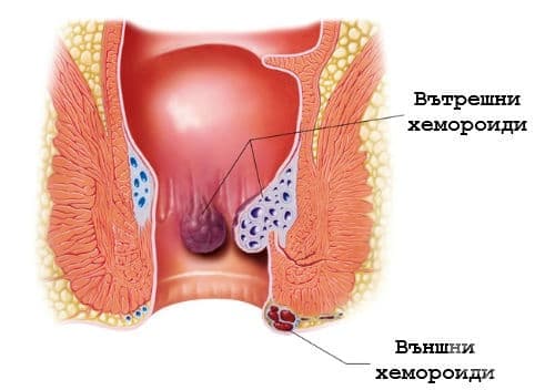 Вътрешни и външни хемороиди