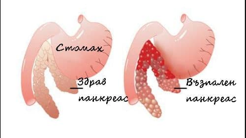 Панкреатит