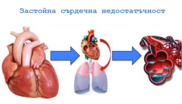 Застойна сърдечна недостатъчност